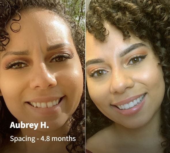 AlignerCo vs Byte Which AtHome Teeth Aligner Is Best?