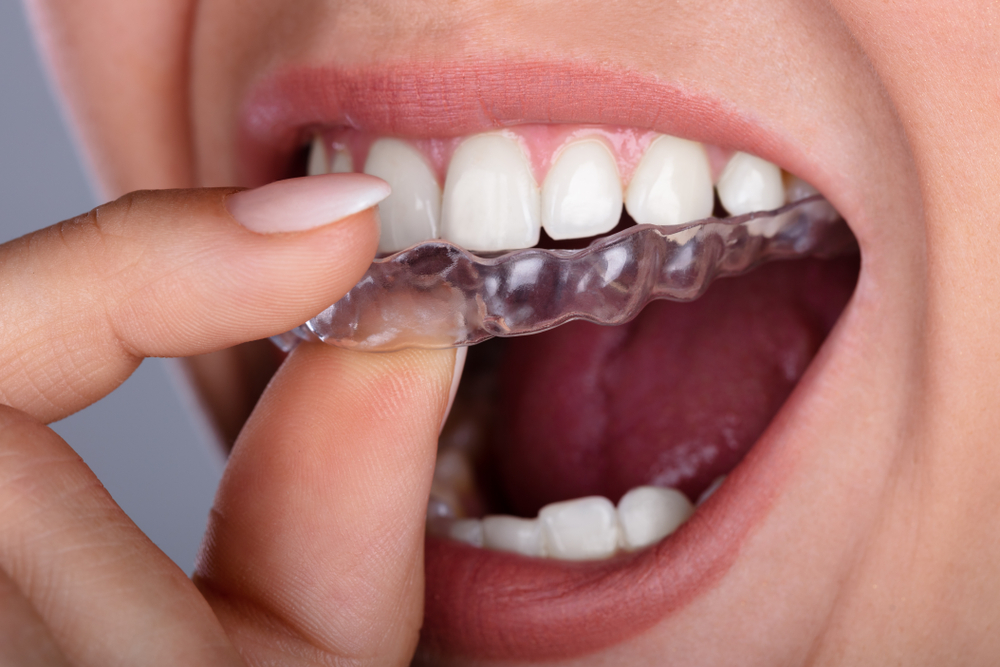 Smile Direct vs Invisalign Which Clear Teeth Aligners Are Best?