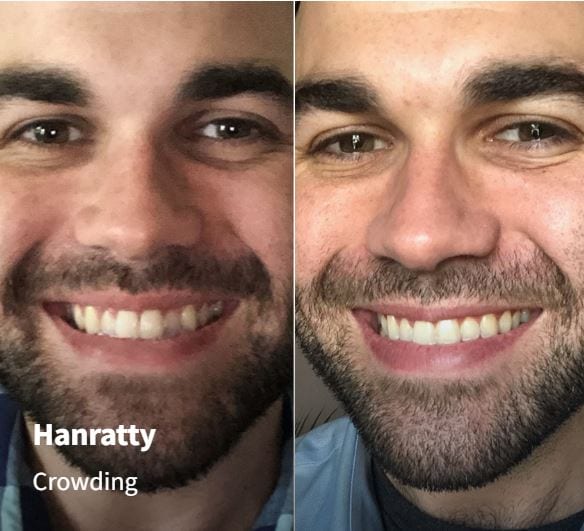 AlignerCo vs Byte Which AtHome Teeth Aligner Is Best?