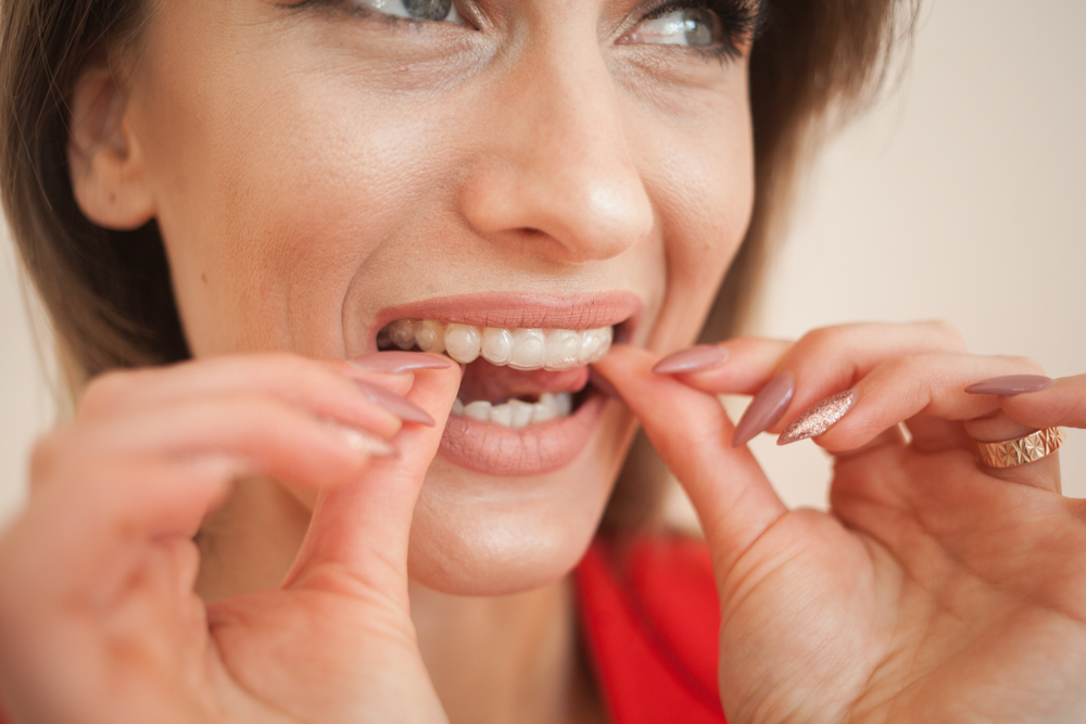 How Much Are Braces? Factors That Impact the Price of Braces, Byte®