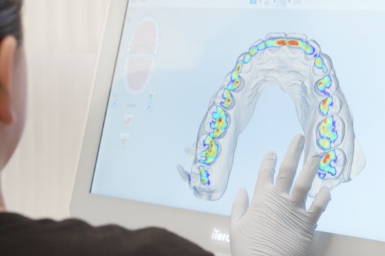 Candid aligner review - scans