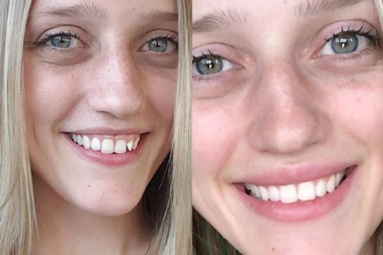 Candid aligner review - candid before and after